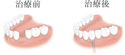 1本の歯が欠けている場合