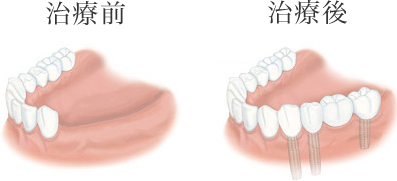 数本の歯が欠けている場合