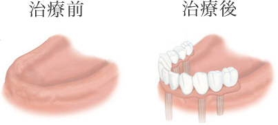 全ての歯が欠けている場合