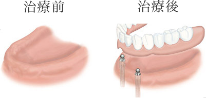 全ての歯が欠けている場合