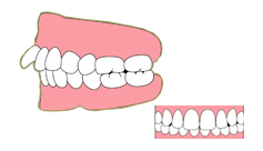 上顎前突（出っ歯）