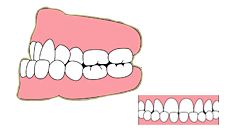 反対咬合（受け口）