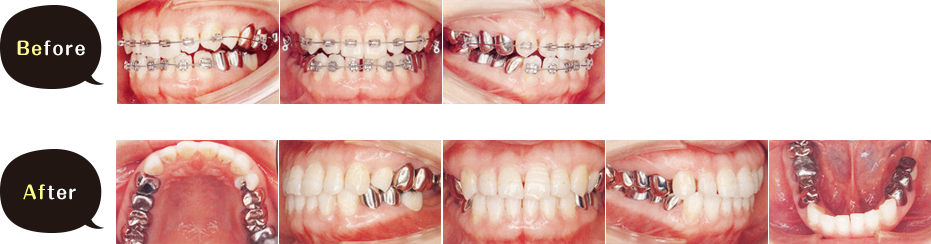 メタルブラケット