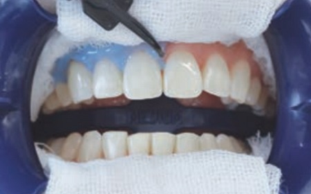 1．歯肉・粘膜保護