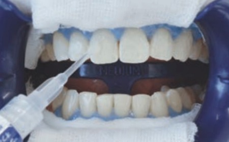 3．ホワイトニングジェル塗布