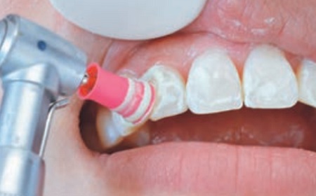 5．歯面清掃