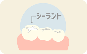シーラント