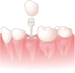 ファイバーコア