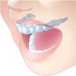 クリアライナー