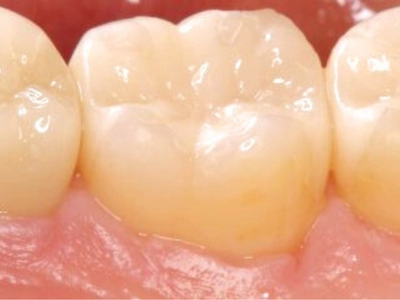 ハイグレードジルコニア冠