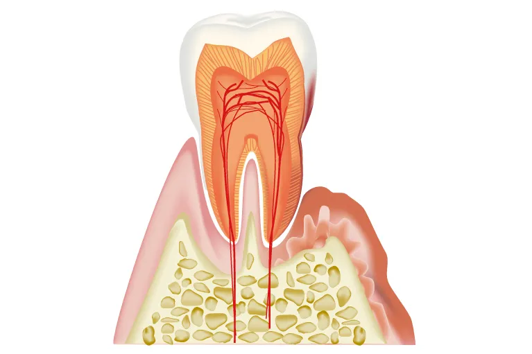 こんな症状があったら歯周病かもしれません