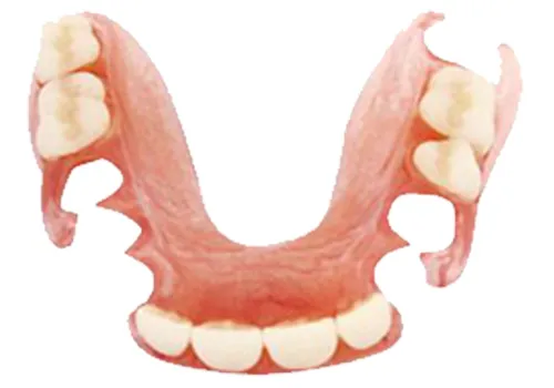 ノンクラスプデンチャー