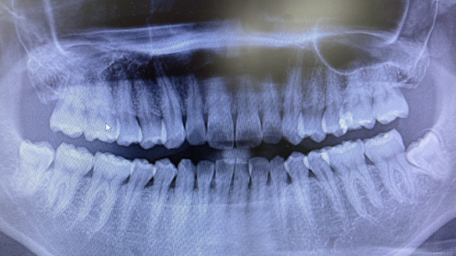 抜歯の必要性の有無