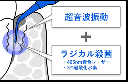 ブルーラジカルによる歯周病治療