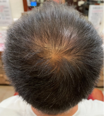 施術前のつむじ