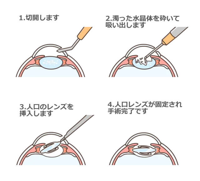 白内障手術について