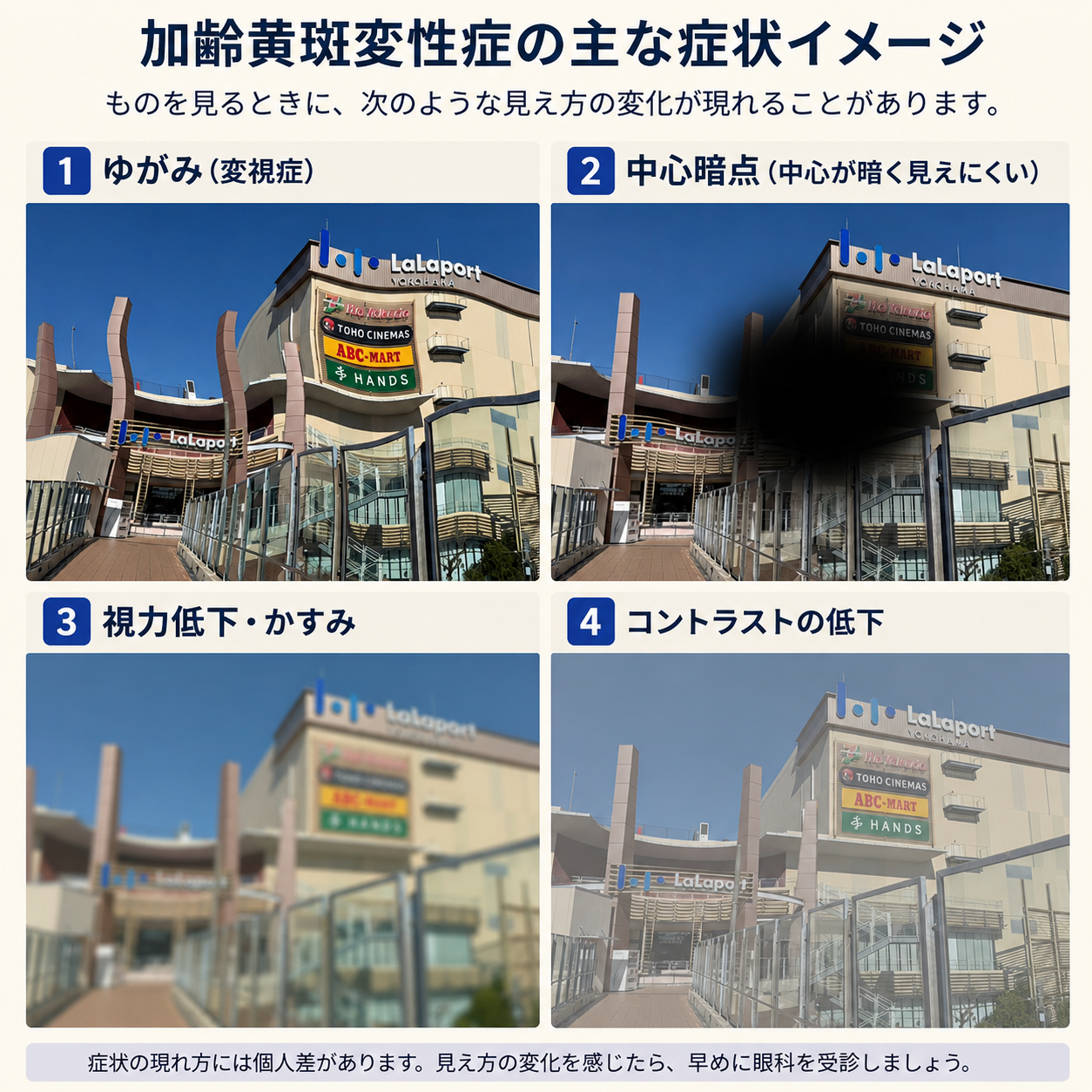 加齢黄斑変性の見え方のイメージ（歪み・中心暗点・視力低下・コントラスト低下）