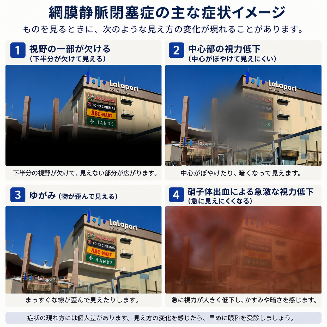 網膜静脈閉塞症の症状イメージ（視野の一部が欠ける・中心部の視力低下・ゆがみ・硝子体出血による急激な視力低下）