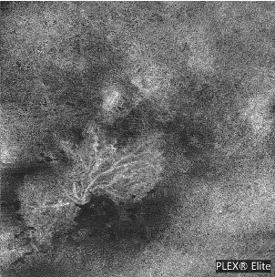 滲出型加齢黄斑変性のOCTA画像