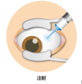 硝子体内注射