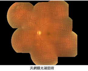 網膜光凝固術