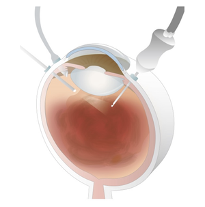 網膜硝子体の日帰り手術