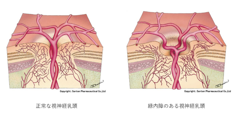 正常な視神経乳頭と緑内障のある視神経乳頭の比較