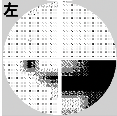 視野検査（ハンフリー視野検査）の結果例