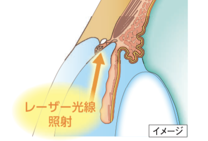 レーザー治療のイメージ