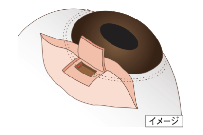 手術のイメージ