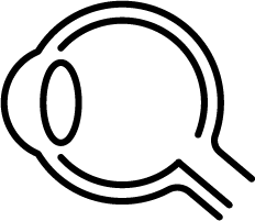 眼内レンズ脱臼