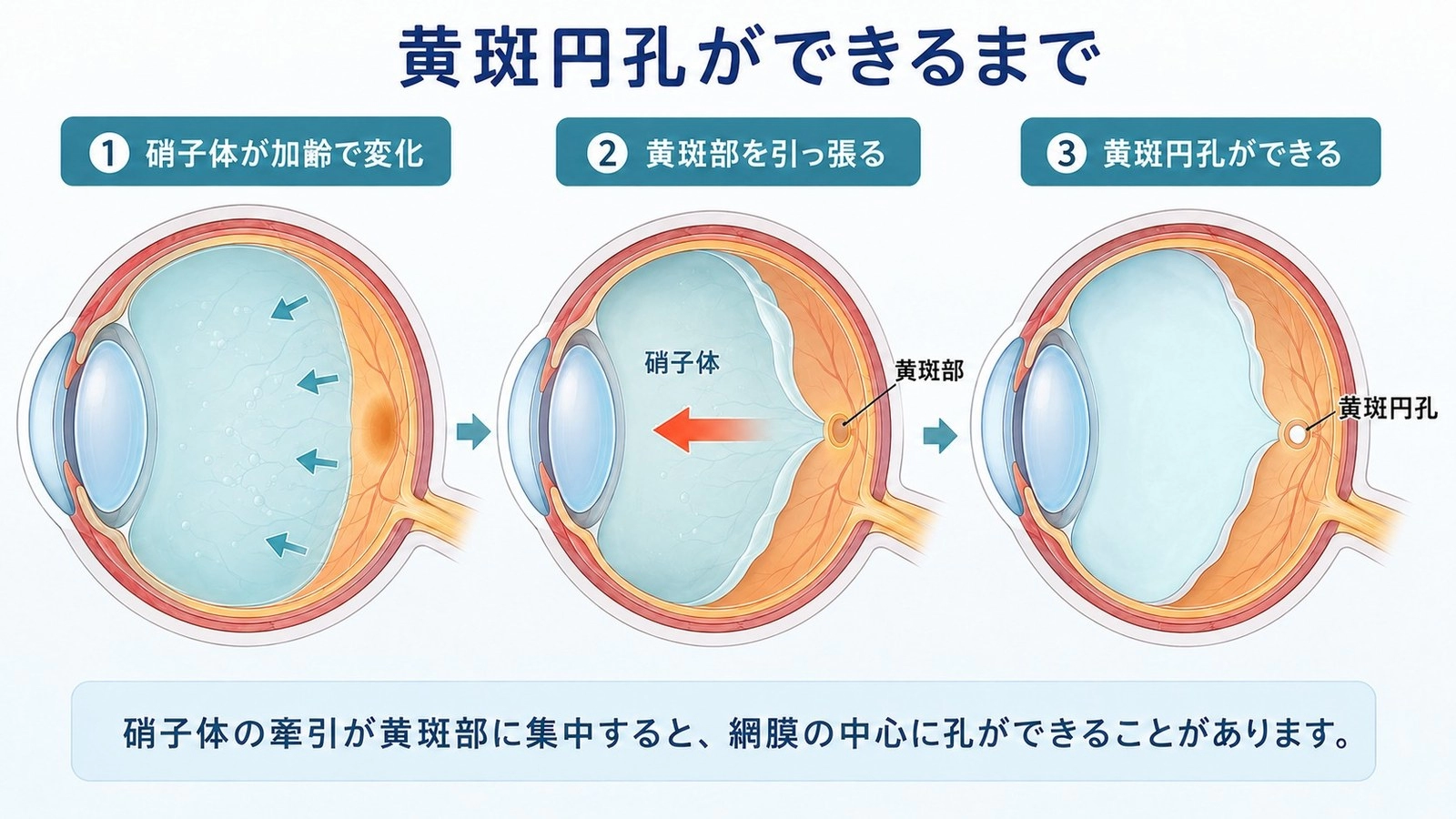 図1 黄斑円孔ができるまで：硝子体が加齢で変化し、黄斑部を引っ張ることで黄斑円孔ができる