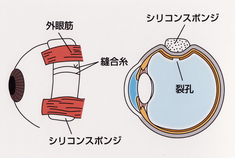 強膜バックル術のイメージ