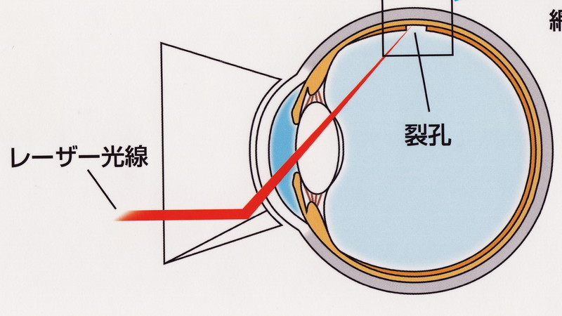 網膜裂孔に対するレーザー治療の様子
