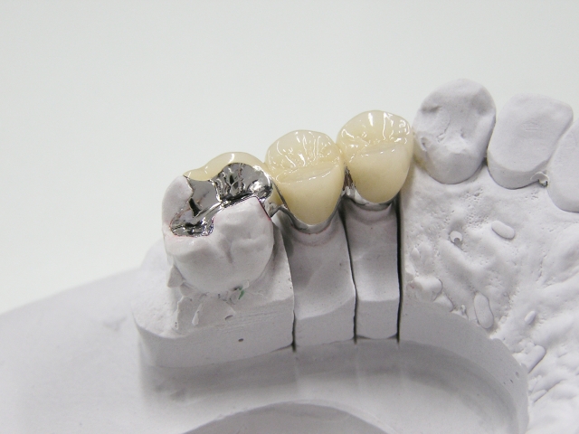 つめ物・かぶせ物