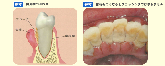 プラーク（歯垢）・歯石の除去