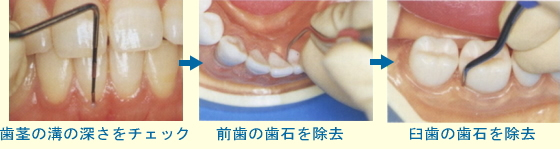 プラーク（歯垢）・歯石除去のステップ