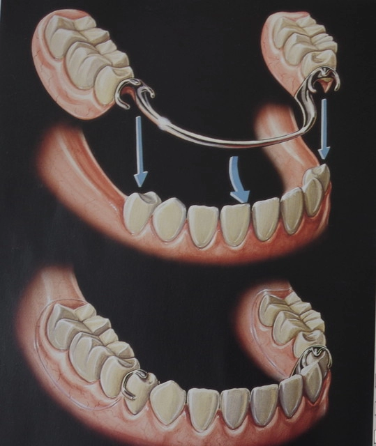 入れ歯（義歯）治療