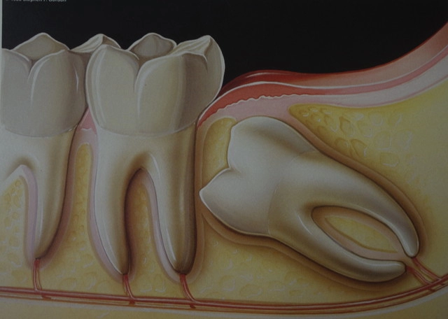 親知らずの抜歯