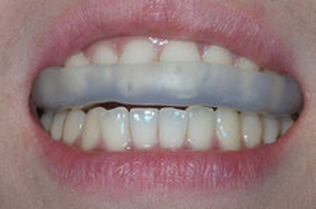 はぎしりの治療