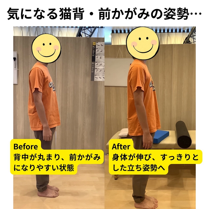 気になる猫背・前かがみの姿勢…／ビフォーアフター