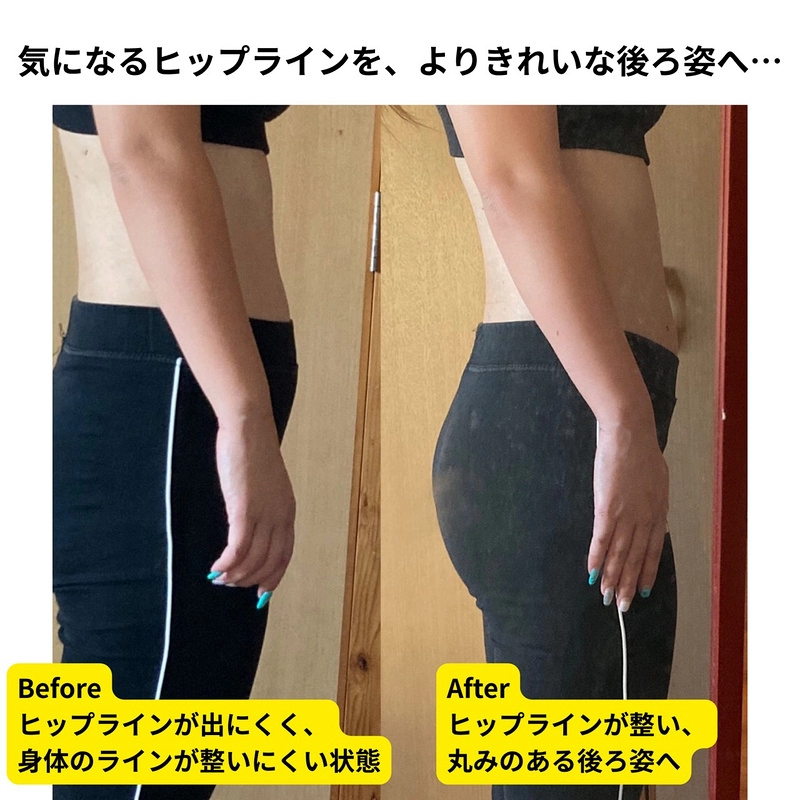 気になるヒップラインを、よりきれいな後ろ姿へ…／ビフォーアフター