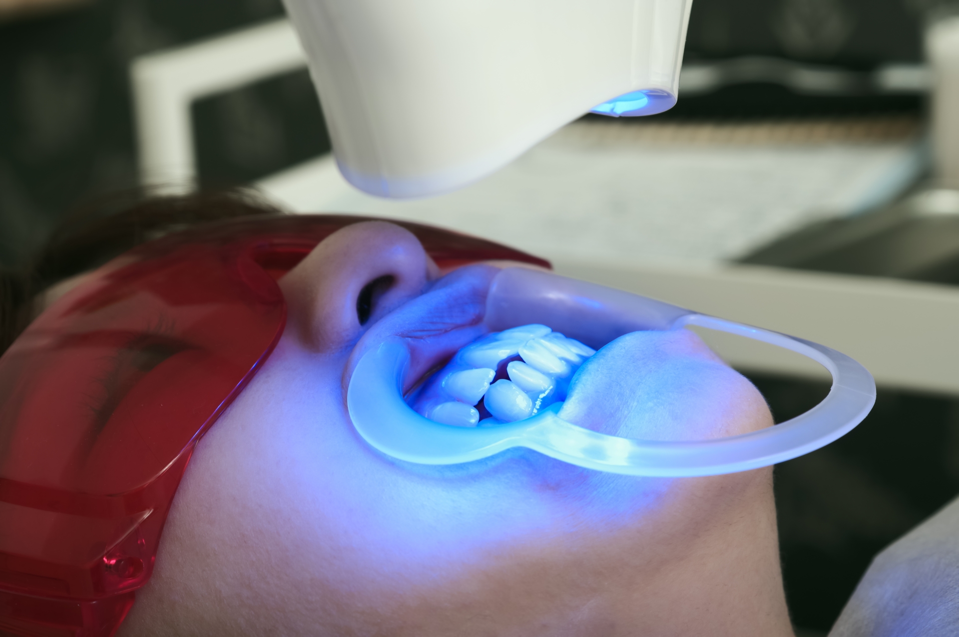 ホワイトニング後の歯