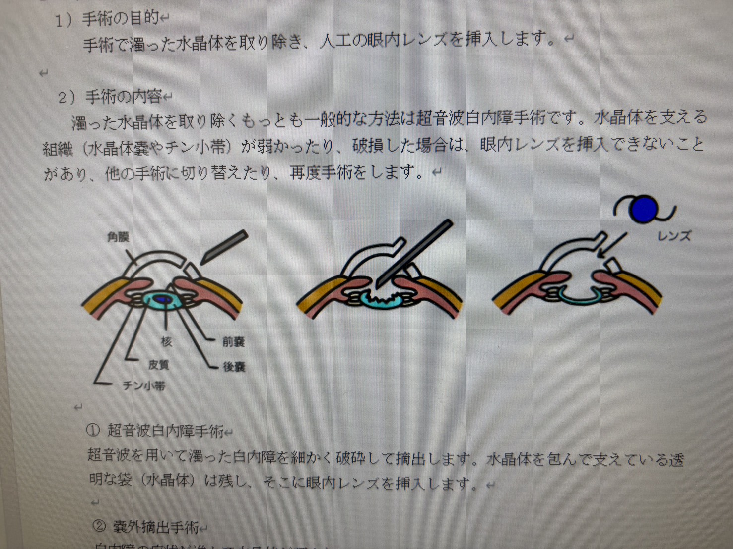 白内障手術イメージ2