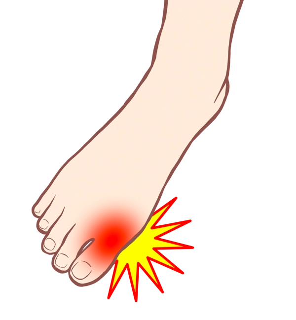 足の親指の付け根が赤く腫れて痛むイラスト