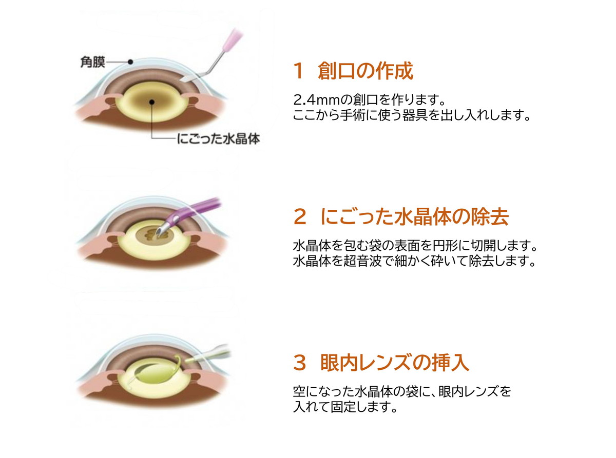 白内障手術の流れ